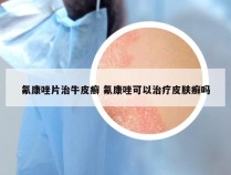 氟康唑片治牛皮癣 氟康唑可以治疗皮肤癣吗