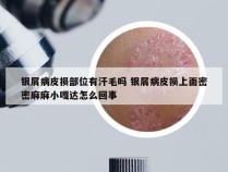 银屑病皮损部位有汗毛吗 银屑病皮损上面密密麻麻小嘎达怎么回事