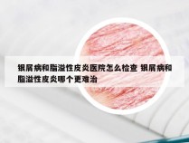 银屑病和脂溢性皮炎医院怎么检查 银屑病和脂溢性皮炎哪个更难治