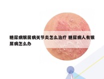糖尿病银屑病关节炎怎么治疗 糖尿病人有银屑病怎么办