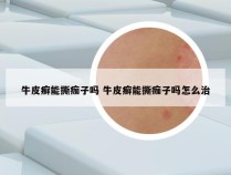 牛皮癣能撕痂子吗 牛皮癣能撕痂子吗怎么治
