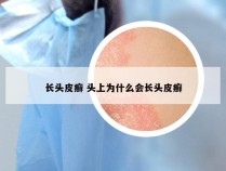 长头皮癣 头上为什么会长头皮癣