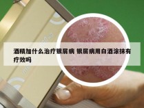 酒精加什么治疗银屑病 银屑病用白酒涂抹有疗效吗