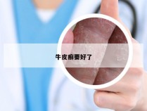 牛皮癣要好了