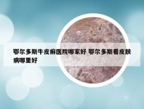 鄂尔多斯牛皮癣医院哪家好 鄂尔多斯看皮肤病哪里好