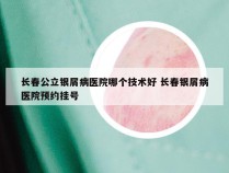 长春公立银屑病医院哪个技术好 长春银屑病医院预约挂号