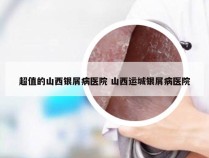 超值的山西银屑病医院 山西运城银屑病医院