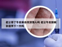 老公得了牛皮癣会找到情人吗 老公牛皮肤癣会遗传下一代吗