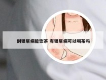 副银屑病能饮茶 有银屑病可以喝茶吗