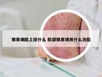 银屑病脸上搽什么 脸部银屑病用什么洗脸
