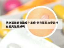 他克莫司软膏治疗牛皮癣 他克莫司软膏治疗白癜风效果好吗