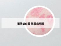 银屑病白醋 银屑病用醋