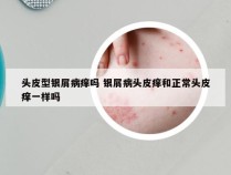 头皮型银屑病痒吗 银屑病头皮痒和正常头皮痒一样吗
