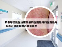 长春哪里能医治银屑病的医院最好的医院最好 长春治银屑病的药膏有哪些