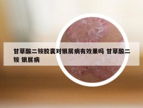 甘草酸二铵胶囊对银屑病有效果吗 甘草酸二铵 银屑病