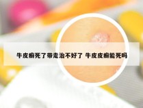 牛皮癣死了带走治不好了 牛皮皮癣能死吗