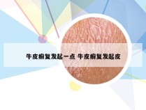 牛皮癣复发起一点 牛皮癣复发起皮