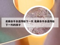 皮癣会不会遗传给下一代 皮癣会不会遗传给下一代的孩子