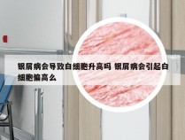 银屑病会导致白细胞升高吗 银屑病会引起白细胞偏高么
