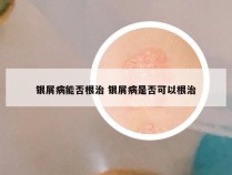 银屑病能否根治 银屑病是否可以根治