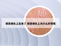 银屑病头上出来了 银屑病头上为什么好得慢