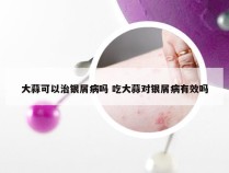 大蒜可以治银屑病吗 吃大蒜对银屑病有效吗