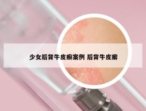 少女后背牛皮癣案例 后背牛皮廨