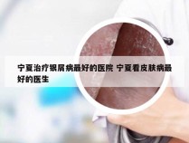宁夏治疗银屑病最好的医院 宁夏看皮肤病最好的医生