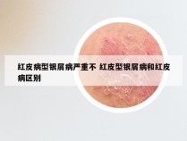 红皮病型银屑病严重不 红皮型银屑病和红皮病区别