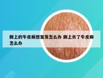 脚上的牛皮癣想复发怎么办 脚上长了牛皮癣怎么办