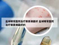 盐城哪家医院治疗银屑病最好 盐城哪家医院治疗银屑病最好的