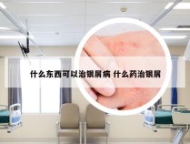 什么东西可以治银屑病 什么药治银屑
