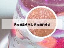 头皮癣是啥什么 头皮癣的症状