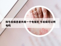 和牛皮癣患者共用一个电推剪 牛皮癣可以烤电吗
