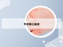 牛皮癣上起皮