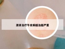 激素治疗牛皮癣越治越严重