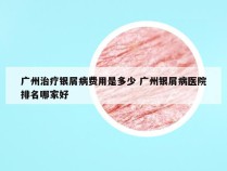 广州治疗银屑病费用是多少 广州银屑病医院排名哪家好