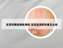 玉泽对银屑病有用吗 玉泽治湿疹效果怎么样