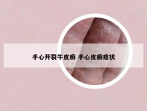 手心开裂牛皮癣 手心皮癣症状
