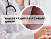 偏方安宫牛黄丸治疗牛皮癣 安宫牛黄丸可以治银屑病吗