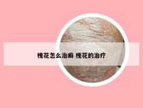 槐花怎么治癣 槐花的治疗