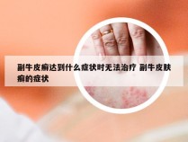 副牛皮癣达到什么症状时无法治疗 副牛皮肤癣的症状
