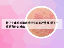 得了牛皮癣能治愈吗还有它的严重性 得了牛皮癣有什么好处