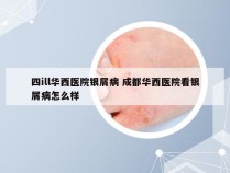 四ill华西医院银屑病 成都华西医院看银屑病怎么样