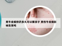 男牛皮癣停药多久可以要孩子 男性牛皮癣影响生育吗