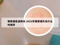 银屑病走进两会 2021年银屑病大会什么时候开