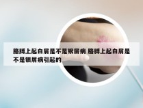 胳膊上起白屑是不是银屑病 胳膊上起白屑是不是银屑病引起的