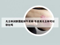 凡士林润肤霜能抹牛皮癣 牛皮用凡士林可以软化吗