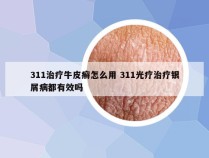 311治疗牛皮癣怎么用 311光疗治疗银屑病都有效吗