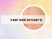 牛皮癣广告如同 治疗牛皮癣广告